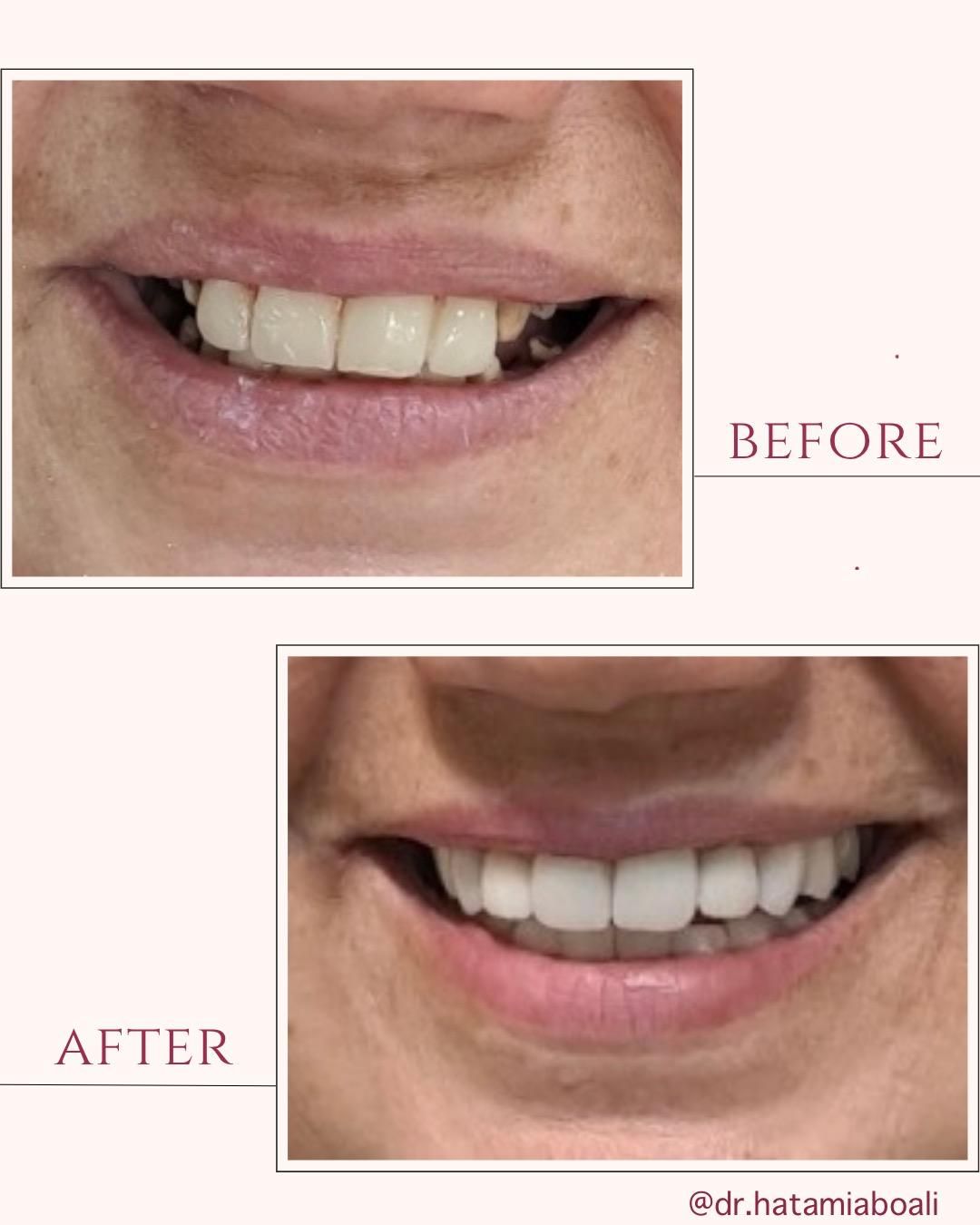 Caz 1 - Before & After