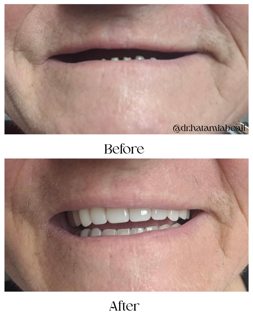 Caz 2 - Before & After