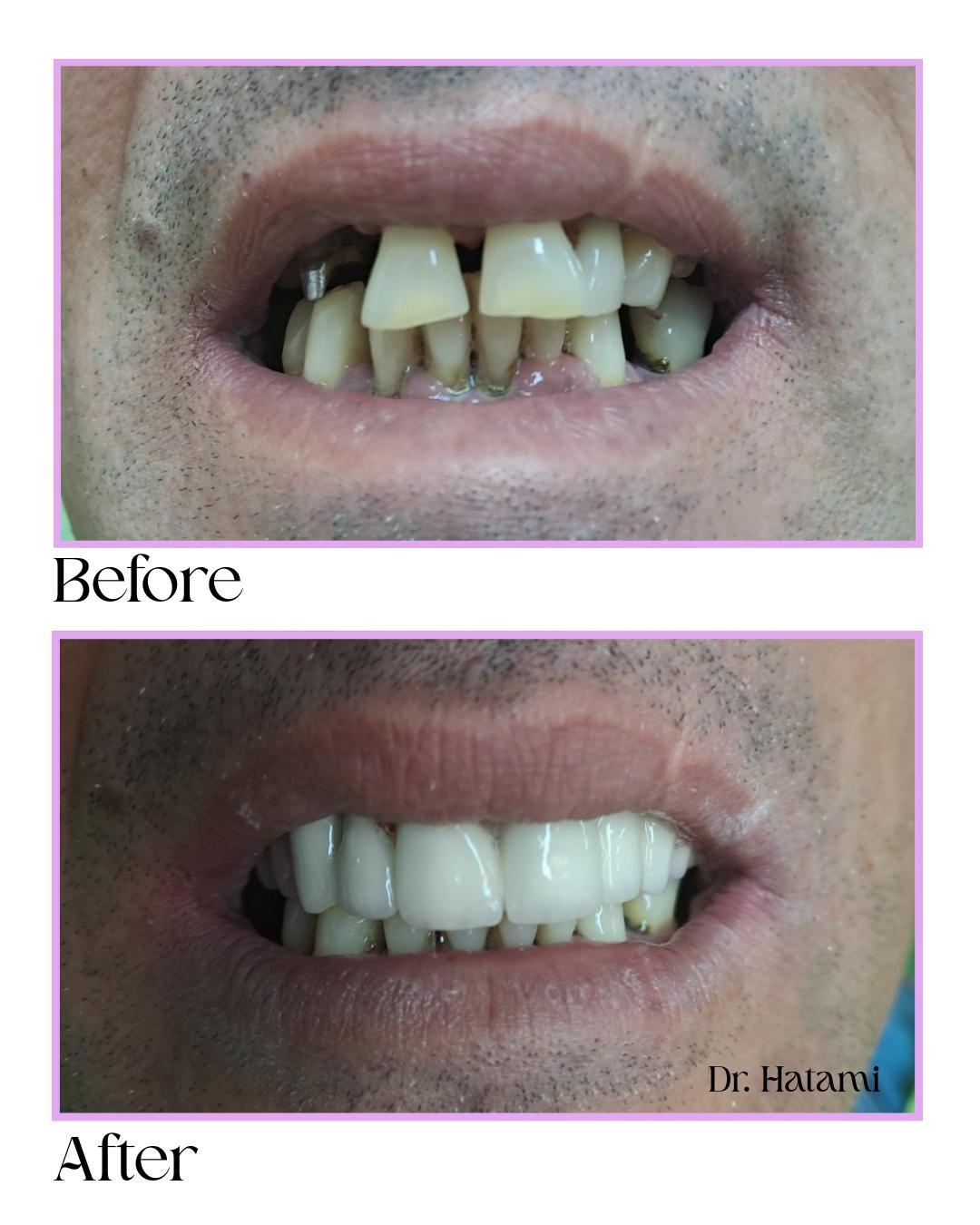 Detaliu Tratament Dentar – Coroane